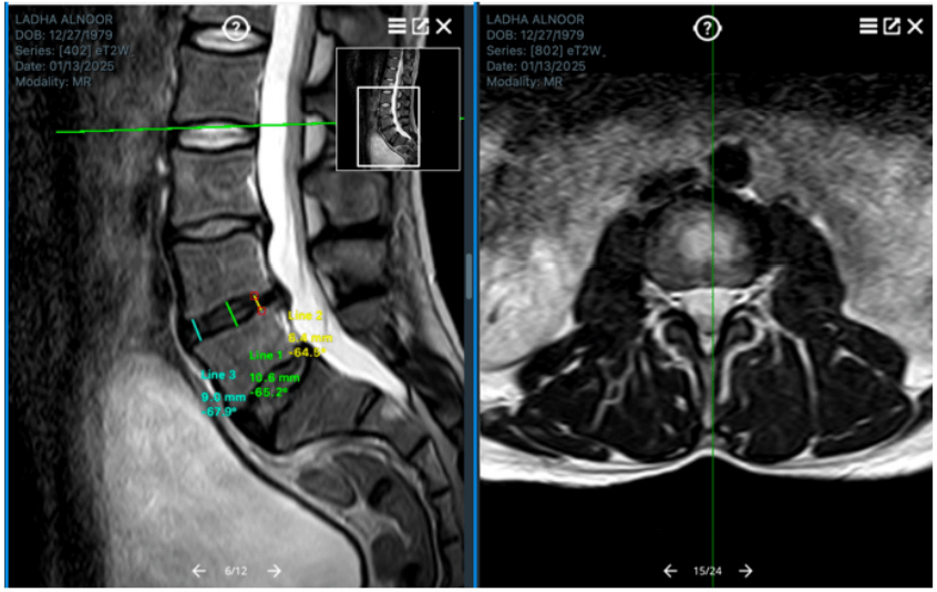 El disco intervertebral como objetivo de terapias regenerativas con láser